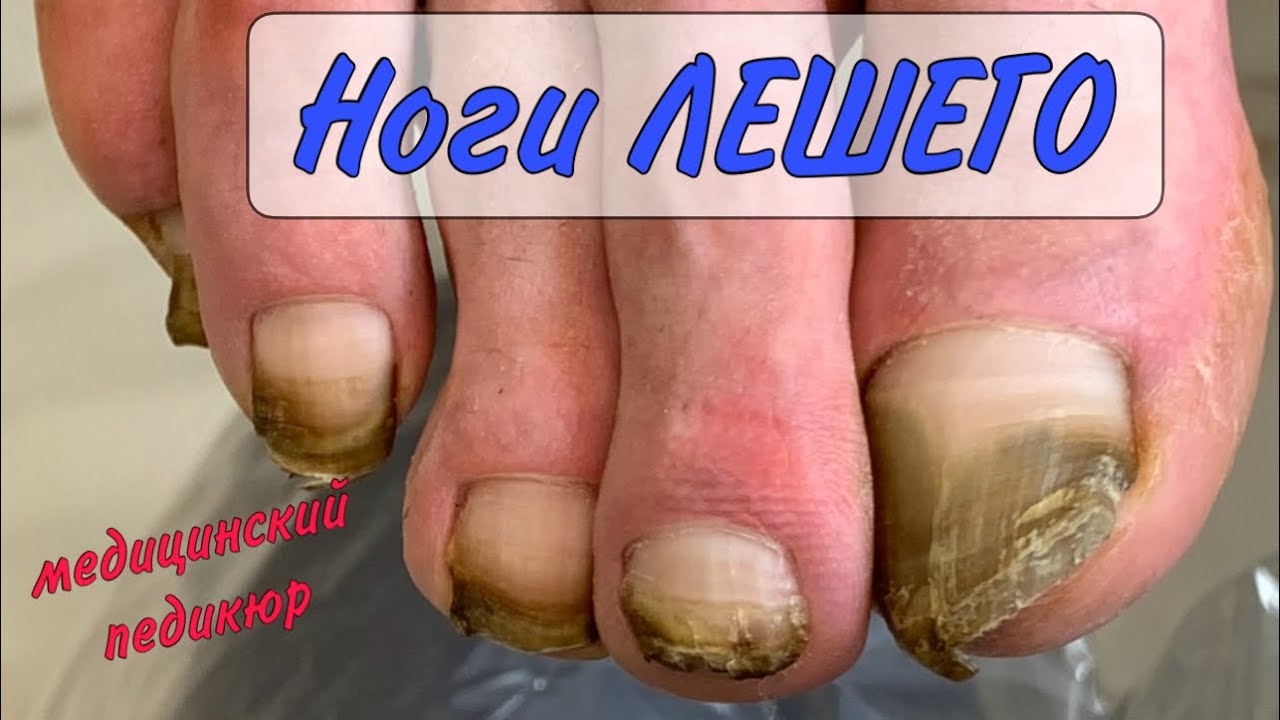 ЛЕШИЙ на педикюре/ Из РАБСТВА на педикюр / медицинский педикюр смотреть онлайн