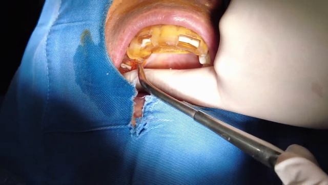 #16,17 implants placement, sinus lifting and alveolar crest bone graft - implant surgical guide смотреть онлайн