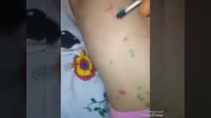 У Полины ветрянка 4-й день