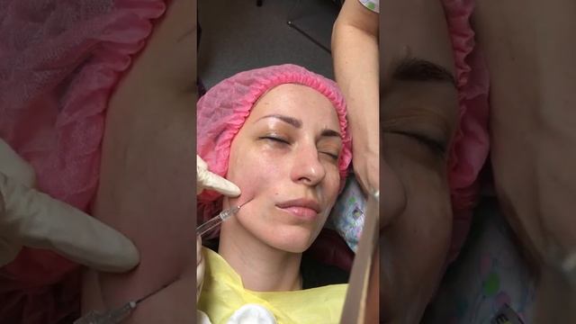 Коррекция носогубных складок. Видеоурок.