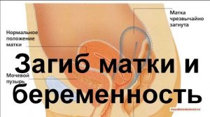 Загиб Матки и Беременность