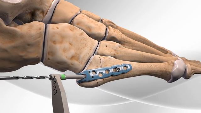 Основание плюсневой синтез смотреть онлайн