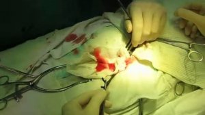 Тромболэктомия - часть 1