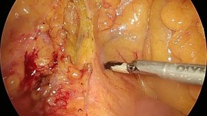 расширенная правосторонняя гемиколэктомия // лапароскопическая гемиколэктомия // right hemicolectom