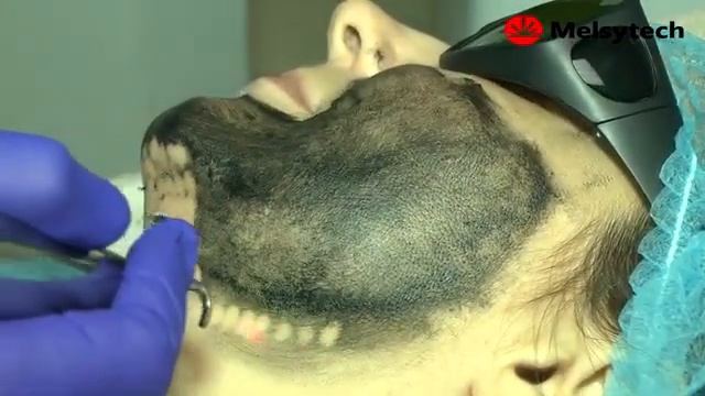 Magic Super Карбоновый пилинг смотреть онлайн