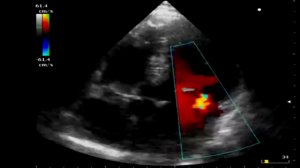 Шум в сердце у ребенка