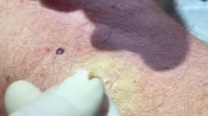 The Blackhead with deep pockets. DPOW blackhead pearl extraction on posterior “popliteal” knee .