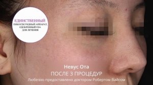 Лазер PicoSure Pro - пикосекундный александритовый лазер для косметологии