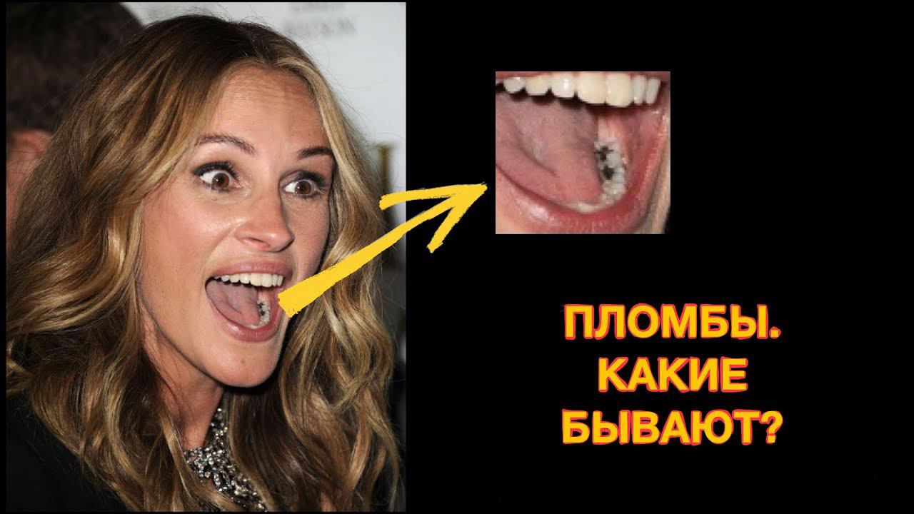 Какие бывают ПЛОМБЫ? Все о пломбах!