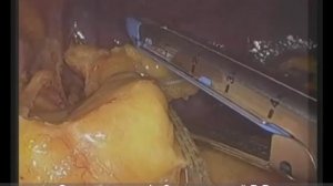 Спленэктомия