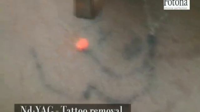 FT лазерное удаление татуировок. Ч.2 смотреть онлайн