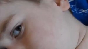 Ювенильный дерматомиозит © juvenile dermatomyositis