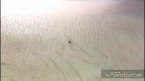 #nasekomyhNet Укус клопа. Как кусает клоп. Постельные клопы.