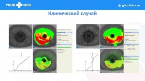 8. "Синдром сухого глаза в практике катарактального хирурга". Майчук Н. В., Москва