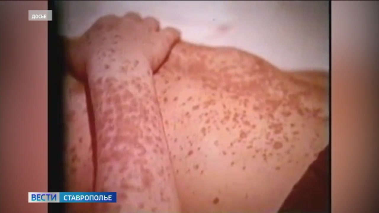 На Ставрополье вспышка кори