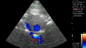 стеноз основной артерии