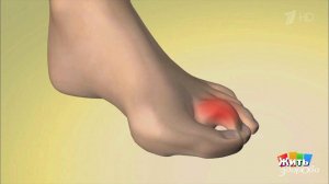 Боль в ногах. Неврома Мортона. Жить здорово! Фрагмент выпуска от 15.05.2019