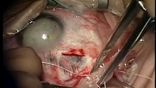 Eye Surgery. Клапан Ахмеда. Офтальмохирург Поздеева Н.А., Чебоксары.