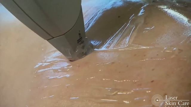 Lightsheer Hair Removal смотреть онлайн