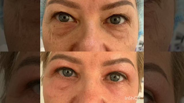 Нет морщинам! Караганда смотреть онлайн