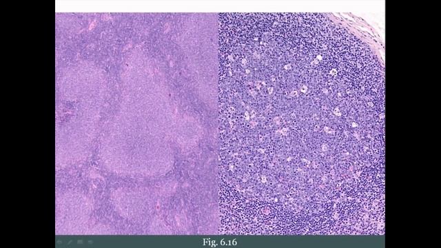 Pathoma USMLE - VI ГЛАВА - 5.Лимфаденопатия, Лимфома, Лимфома Ходжкина