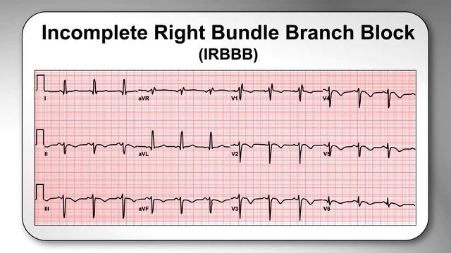 AME Minute: Why is an Incomplete Right Bundle Branch Block considered a normal variant? смотреть онлайн