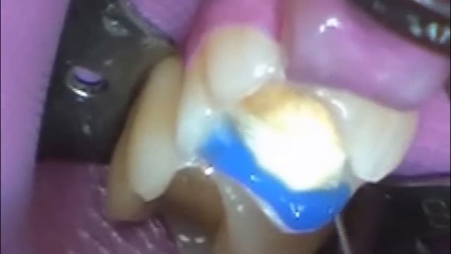 Керамическая вкладка смотреть онлайн