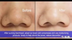 Вакуумный очиститель пор лица COMEDO SUCTION TOOL