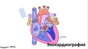 Медицина - просто. Гипертрофия левого желудочка.