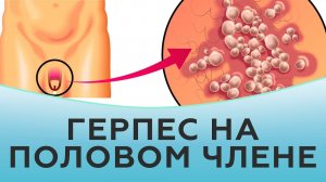 Герпес на половом члене.