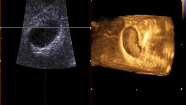 Полипы желчного пузыря на 4 D смотреть онлайн