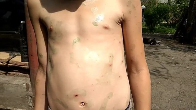 Glister против ветрянки. смотреть онлайн