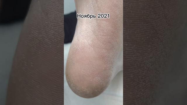 Смотрите как КОЛЛАГЕН-ПЕДИКЮР возвращает стопам молодость