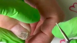 ОНИХОЛИЗИС ⚠️?⚠️ • СИНЕГНОЙНАЯ ПАЛОЧКА????