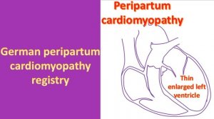 Bromocriptine for peripartum cardiomyopathy