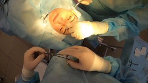 БЛЕФАРОПЛАСТИКА ВЕРХНЕГО ВЕКА! ЗА 8 МИНУТ!!!