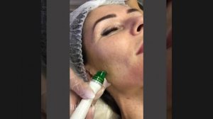 Процедура HydraFacial