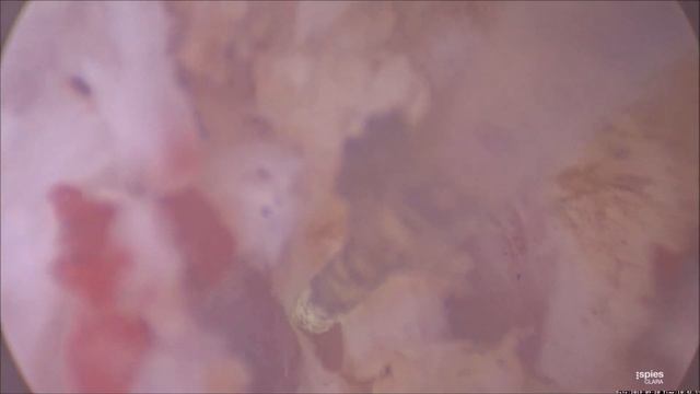 Трансцервикальный адгезиолизис диодным лазером при с-ме Ашермана смотреть онлайн