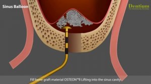 Sinus elevation with crestal approach using sinus balloon