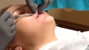АирисКом студенты учатся: французская методика заполнения губ Surgiderm 30 XP