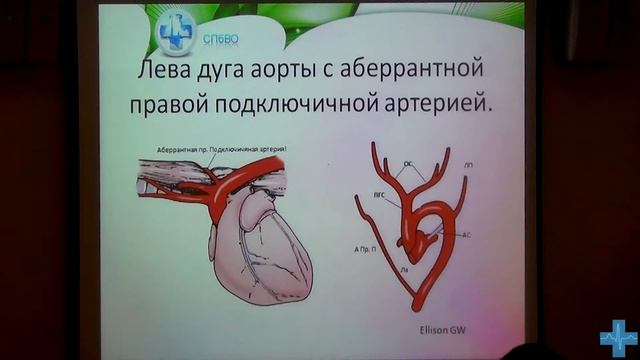 Аномалии сосудистого кольца: варианты, симптомы, диагностика