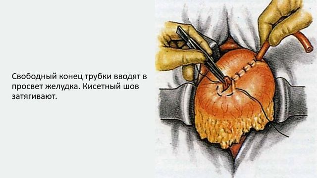 Гастростомия по Витцелю. Оперативная хирургия.
