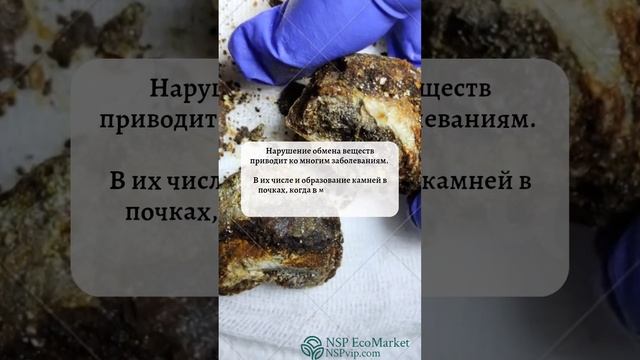 Откуда берутся камни в почках?