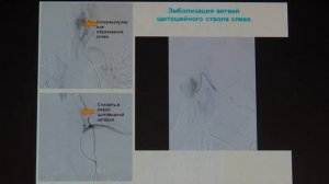 08 Горбачёв СА – Эндоскопическое удаление рецидивной кавернозной гемангиомы шейного отдела пищевода