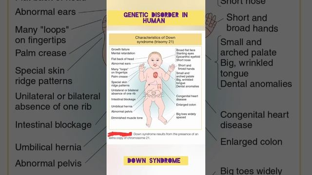 Down Syndrome | Trisomy 21 | Genetic Disorder in Human