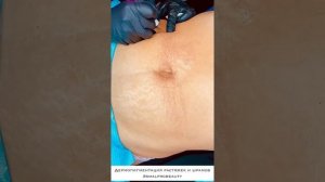 Дермопигментация - камуфляж растяжек и шрамов #камуфляж #камуфляжсмаль #кольщиксмаль #растяжки