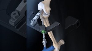 Интрамедуллярный остеосинтез большеберцовой кости \ Іntramedullary osteosynthesis of the tibia