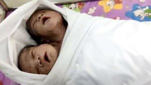 Женщина родила двухголового ребёнка! Врачи были в ужасе от увиденного!