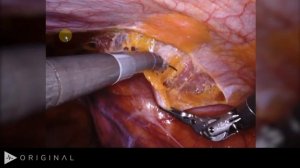 Хирургическая (живая) anatomy of myopectineal orifice