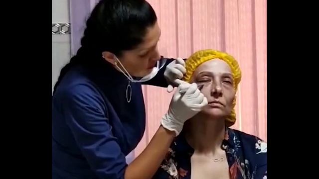 Разметка лица для канюльного введения препарата Eye's Constructor смотреть онлайн